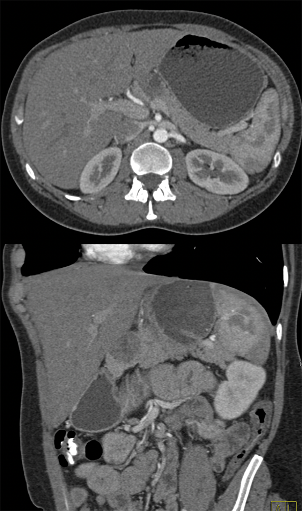 SPEN Tumors of the Pancreas