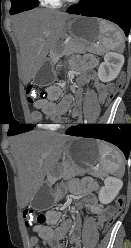 SPEN Tumors of the Pancreas