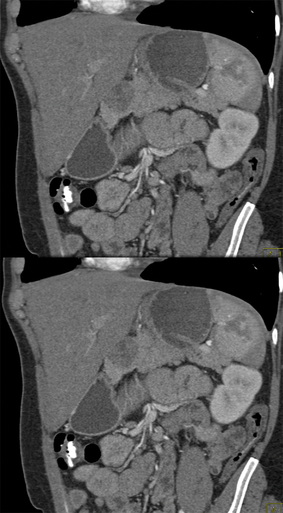 SPEN Tumors of the Pancreas