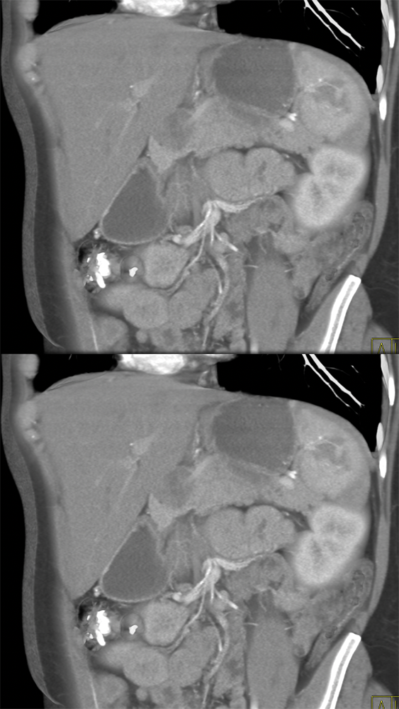 SPEN Tumors of the Pancreas