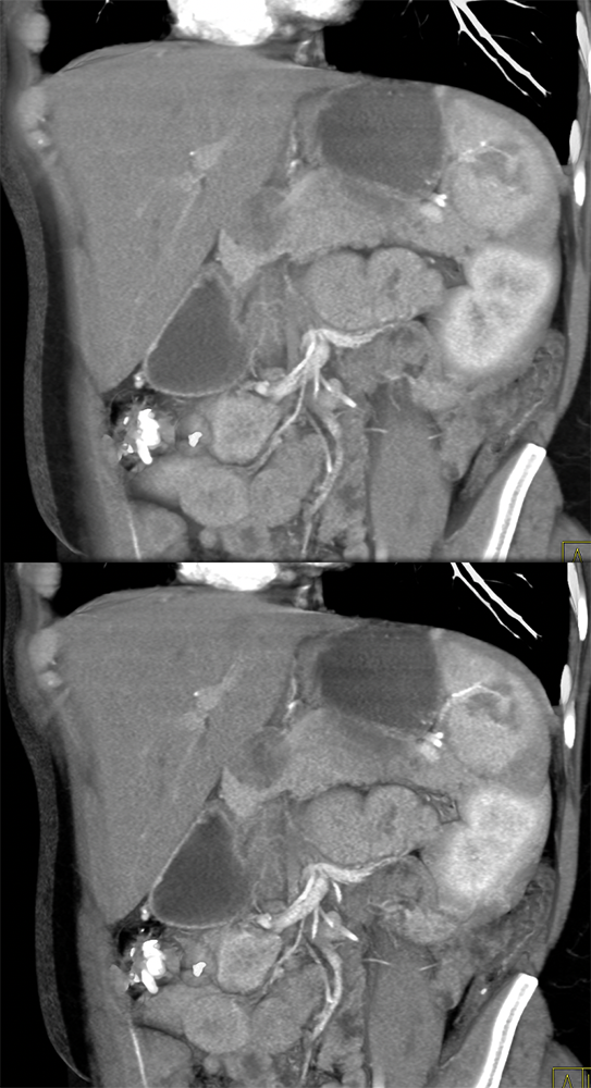 SPEN Tumors of the Pancreas