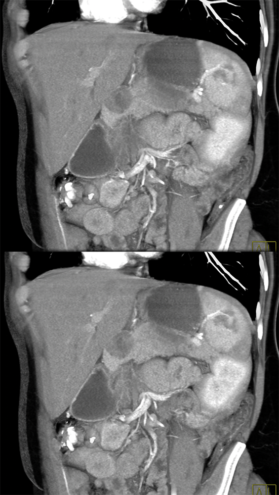 SPEN Tumors of the Pancreas