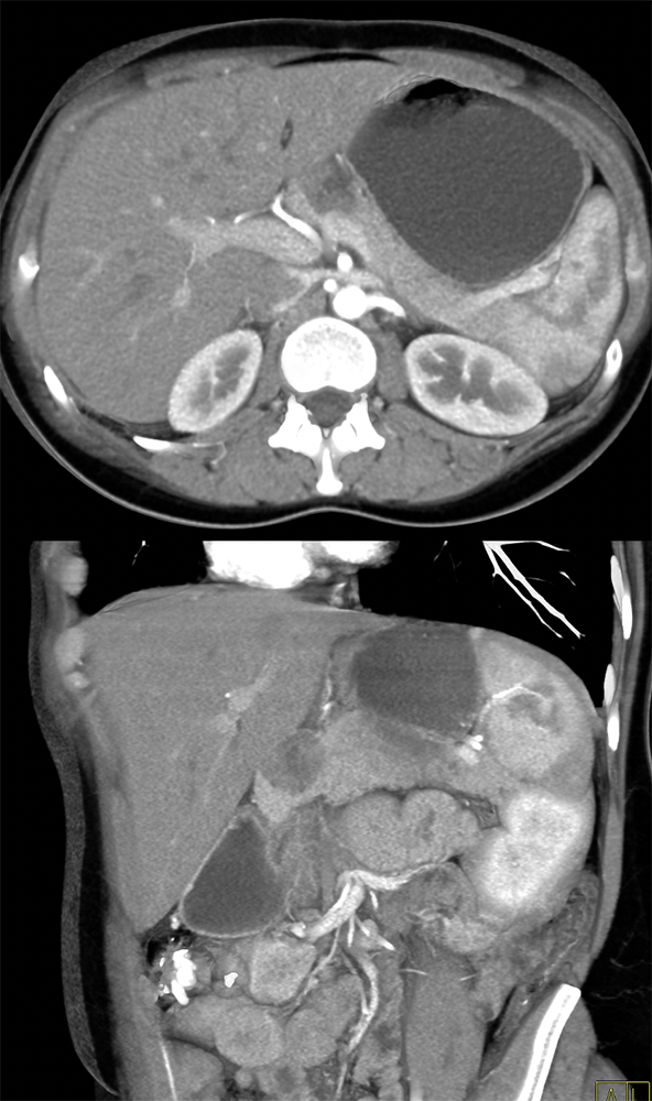 SPEN Tumors of the Pancreas