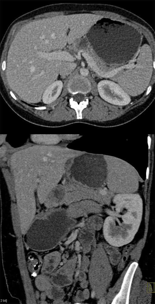 SPEN Tumors of the Pancreas