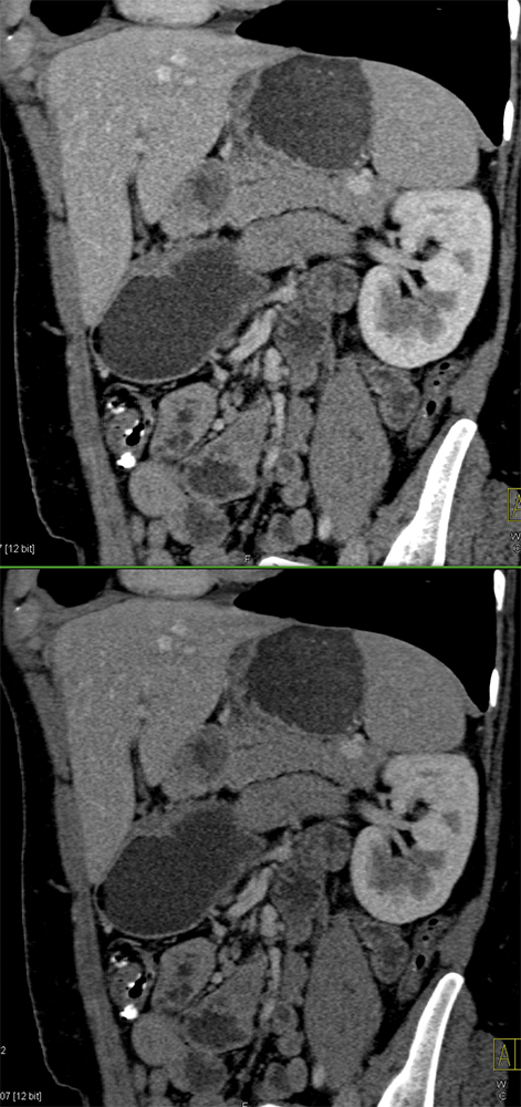 SPEN Tumors of the Pancreas