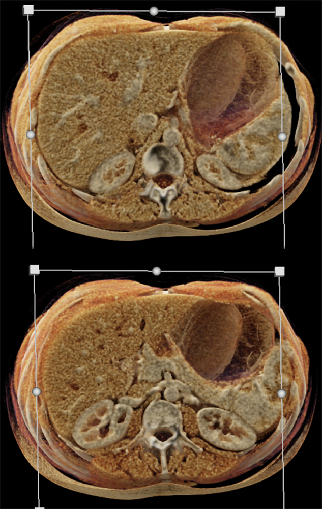 SPEN Tumors of the Pancreas