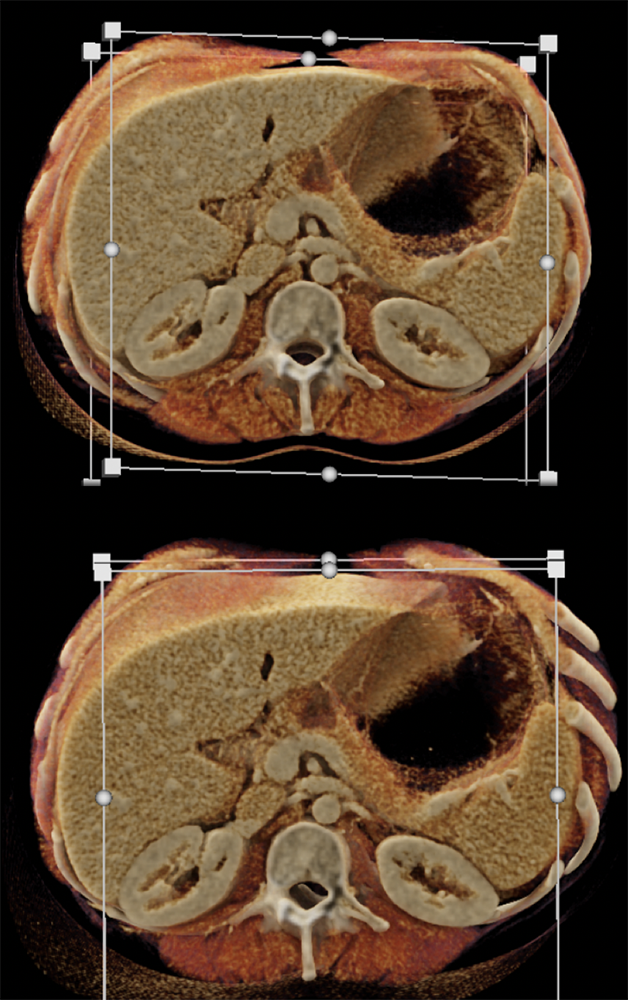 SPEN Tumors of the Pancreas