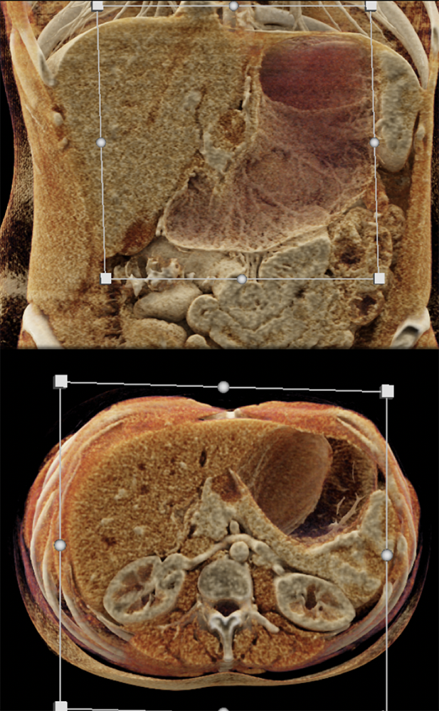 SPEN Tumors of the Pancreas