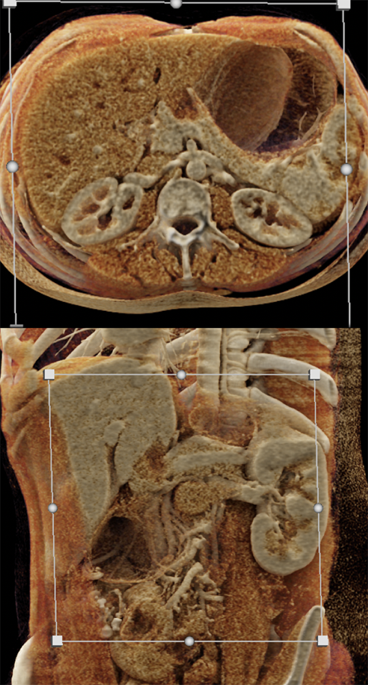 SPEN Tumors of the Pancreas