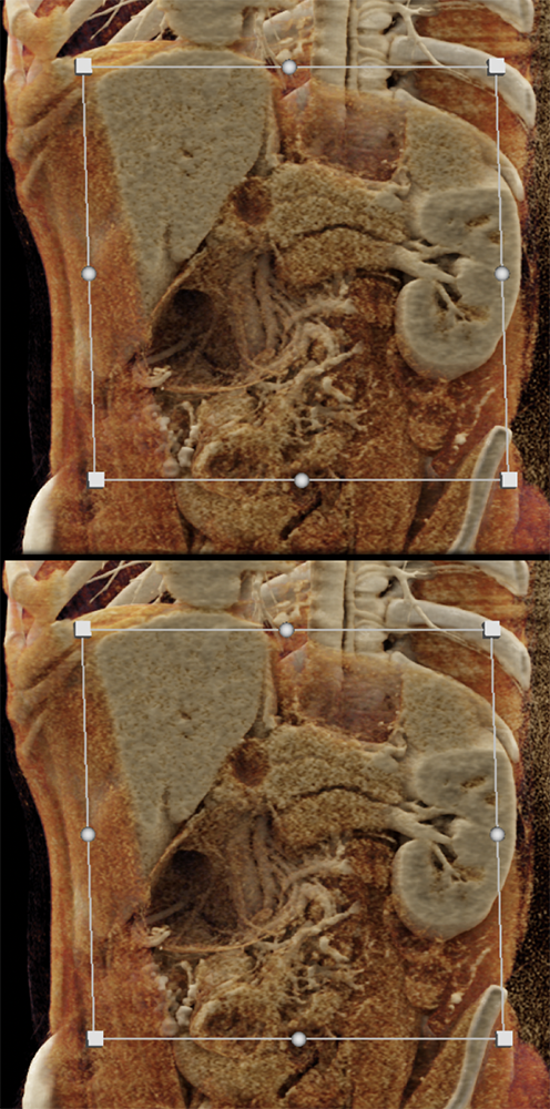 SPEN Tumors of the Pancreas