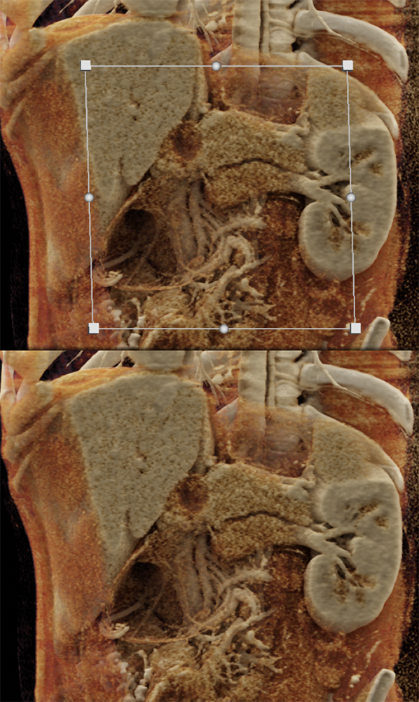 SPEN Tumors of the Pancreas