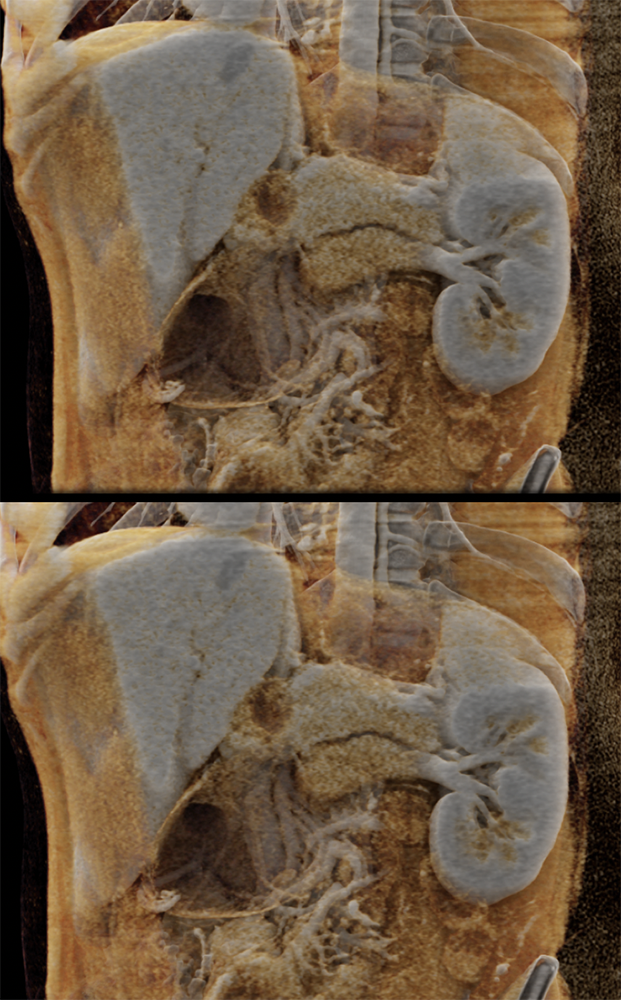 SPEN Tumors of the Pancreas