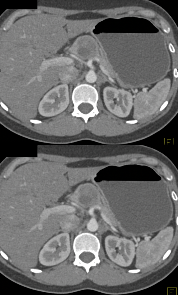 Cystic Pancreatic Mass: SPEN in 30 Female