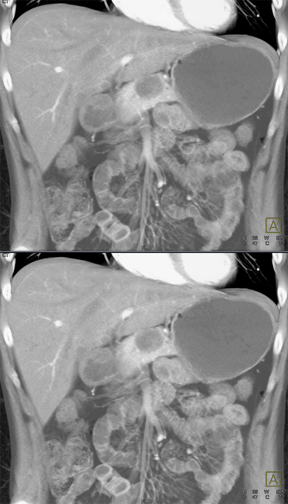 SPEN Tumors of the Pancreas