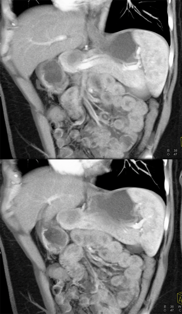 SPEN Tumors of the Pancreas