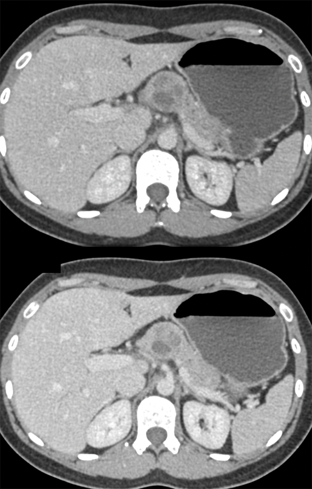 SPEN Tumors of the Pancreas