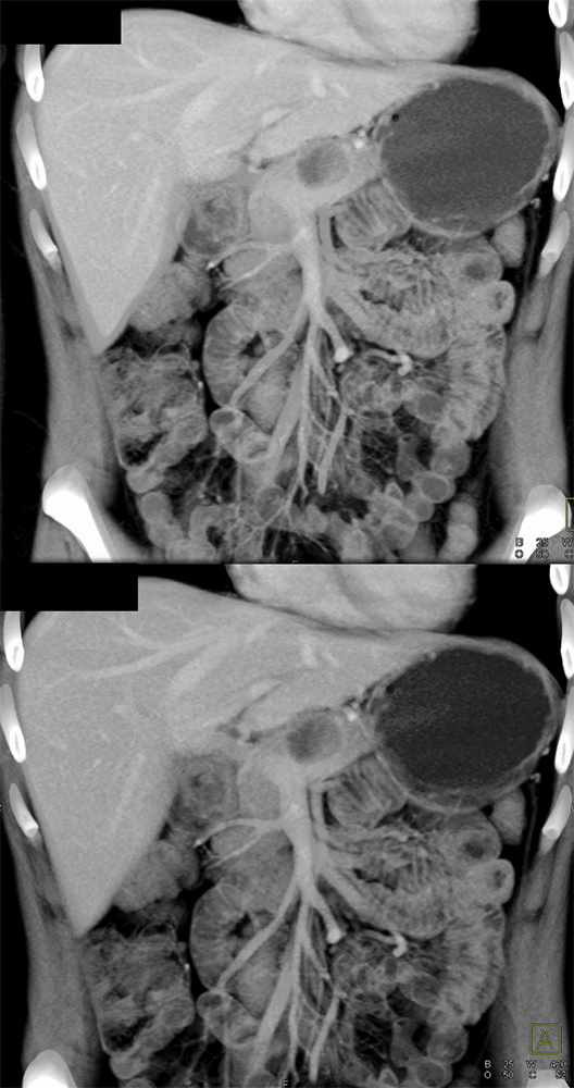 SPEN Tumors of the Pancreas