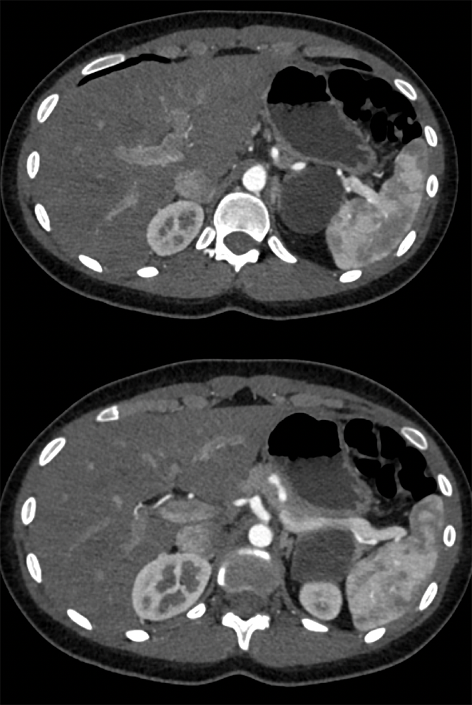 LUQ Pain in 19 yr old Female: SPEN