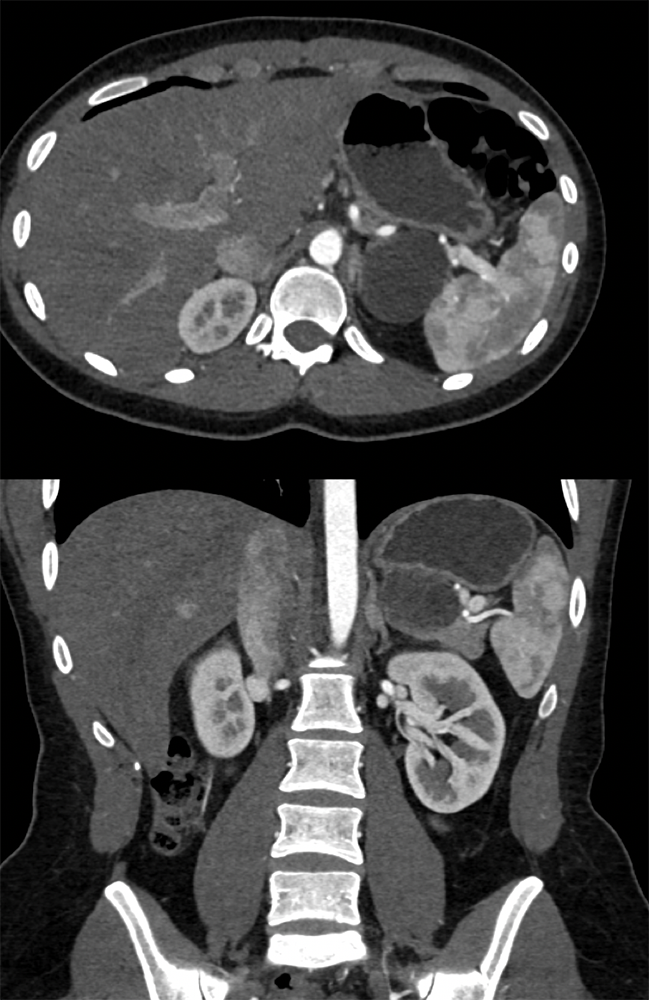 SPEN Tumors of the Pancreas