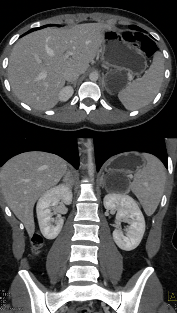 SPEN Tumors of the Pancreas