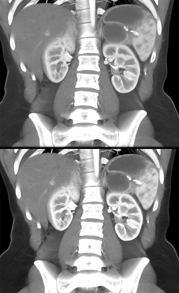 SPEN Tumors of the Pancreas