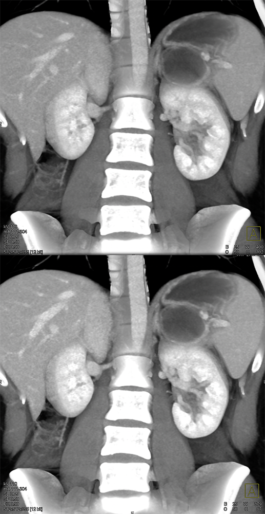 SPEN Tumors of the Pancreas