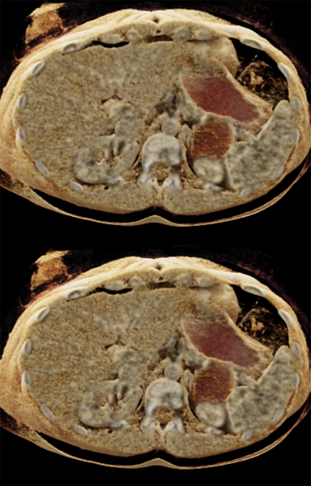 SPEN Tumors of the Pancreas