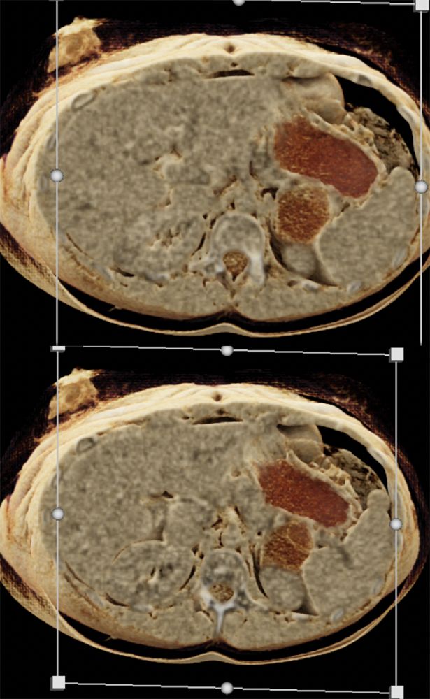 SPEN Tumors of the Pancreas