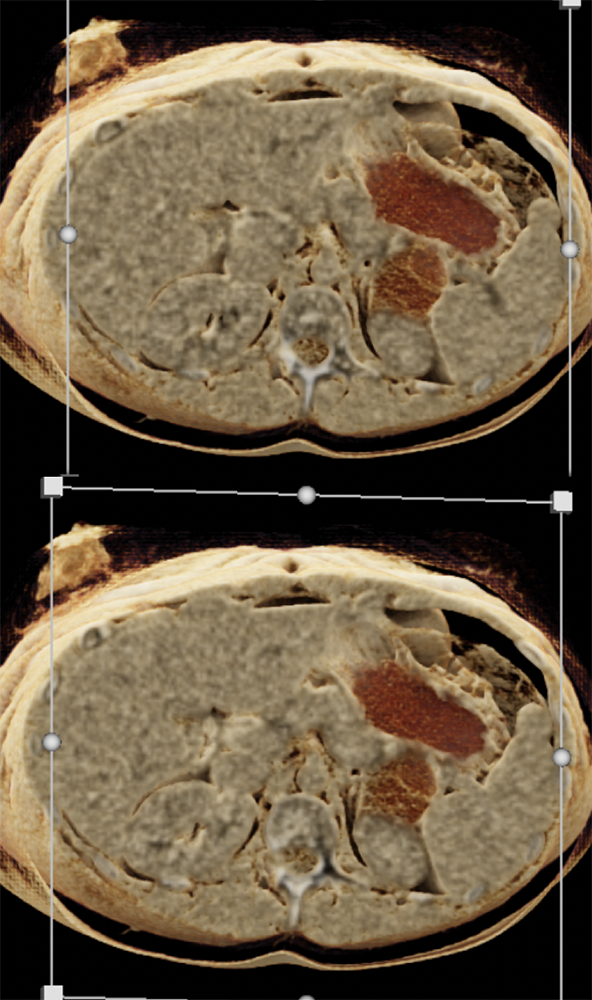 SPEN Tumors of the Pancreas