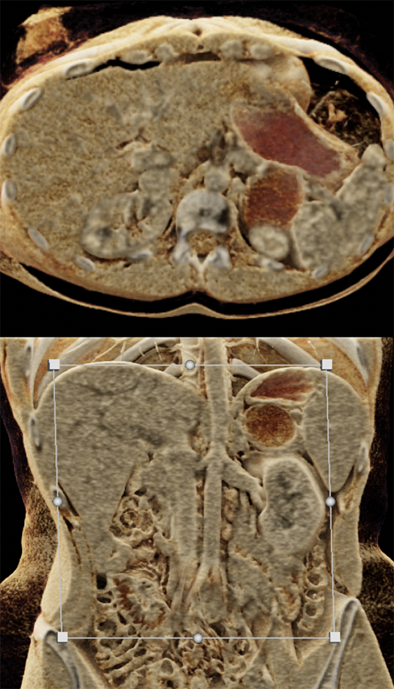 SPEN Tumors of the Pancreas