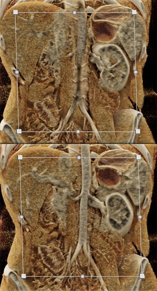 SPEN Tumors of the Pancreas