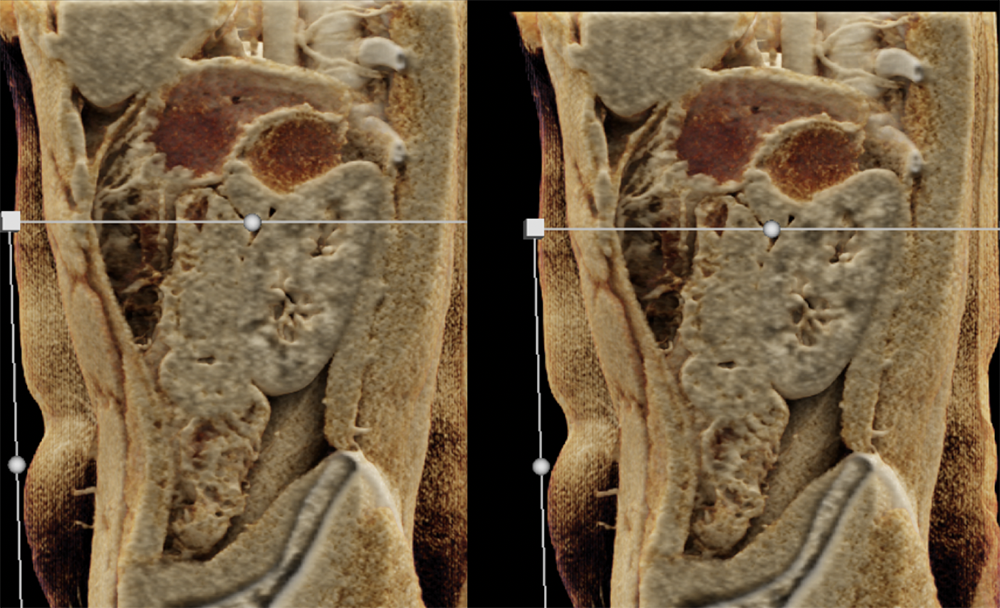 SPEN Tumors of the Pancreas