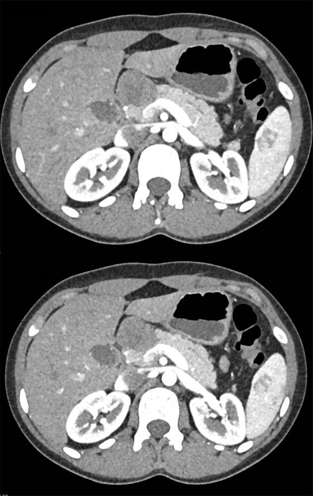 Evaluate Pancreatic Mass