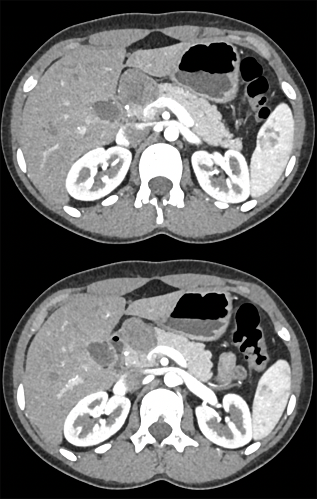 SPEN Tumors of the Pancreas