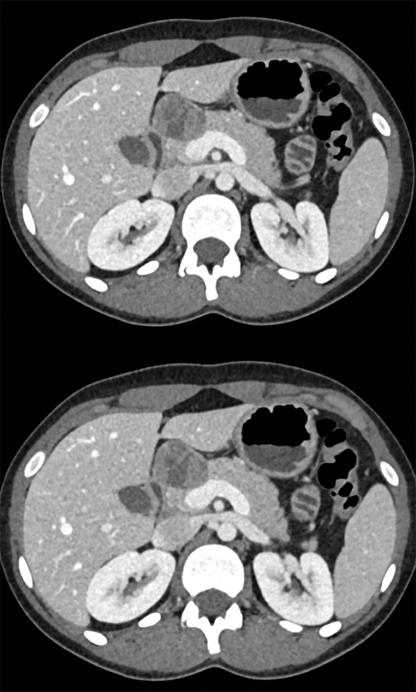 SPEN Tumors of the Pancreas