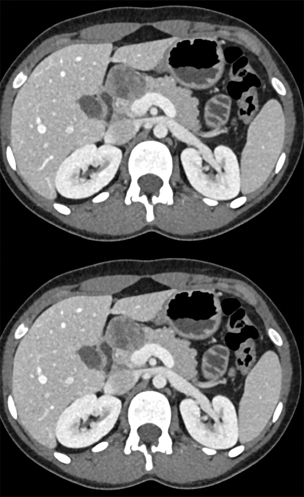 SPEN Tumors of the Pancreas