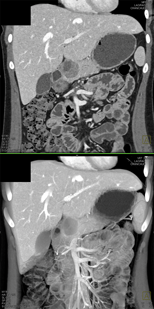 SPEN Tumors of the Pancreas