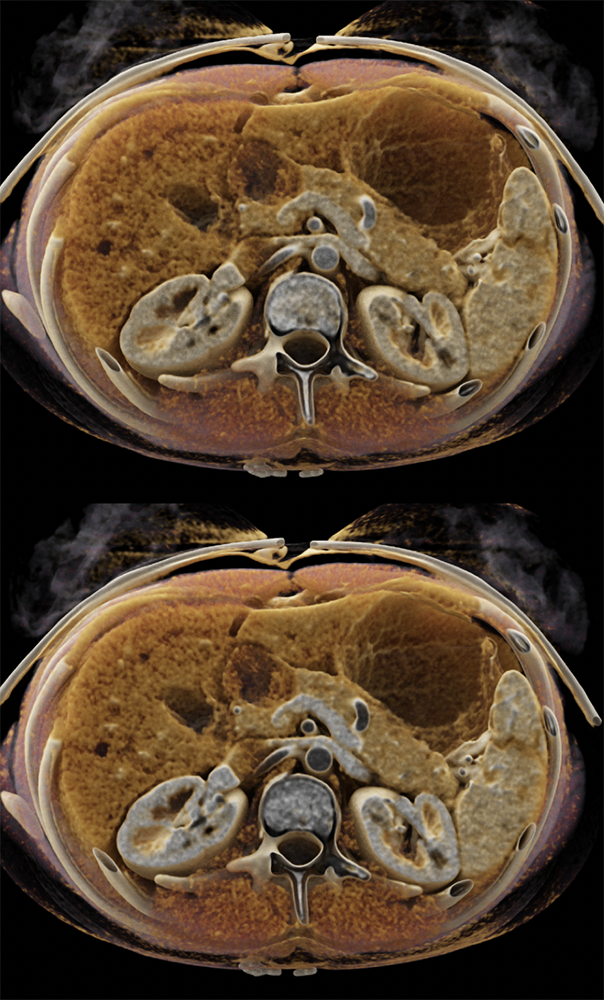 SPEN Tumors of the Pancreas