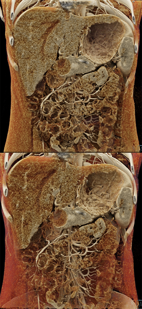 SPEN Tumors of the Pancreas