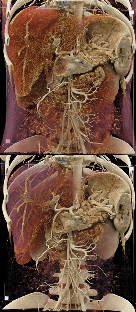 SPEN Tumors of the Pancreas