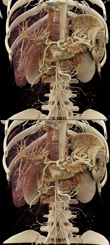 SPEN Tumors of the Pancreas