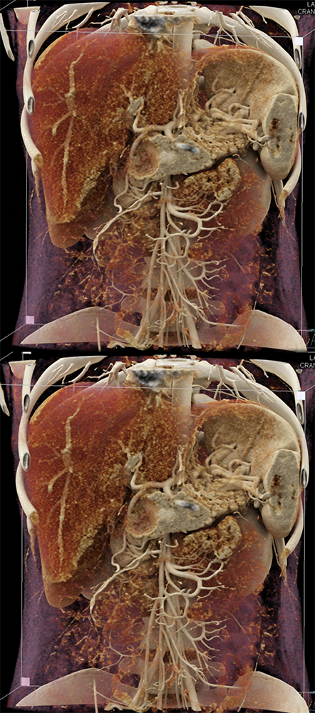 SPEN Tumors of the Pancreas