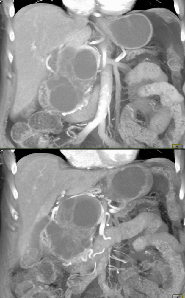 Cystic and Solid Pancreatic Mass: SPEN