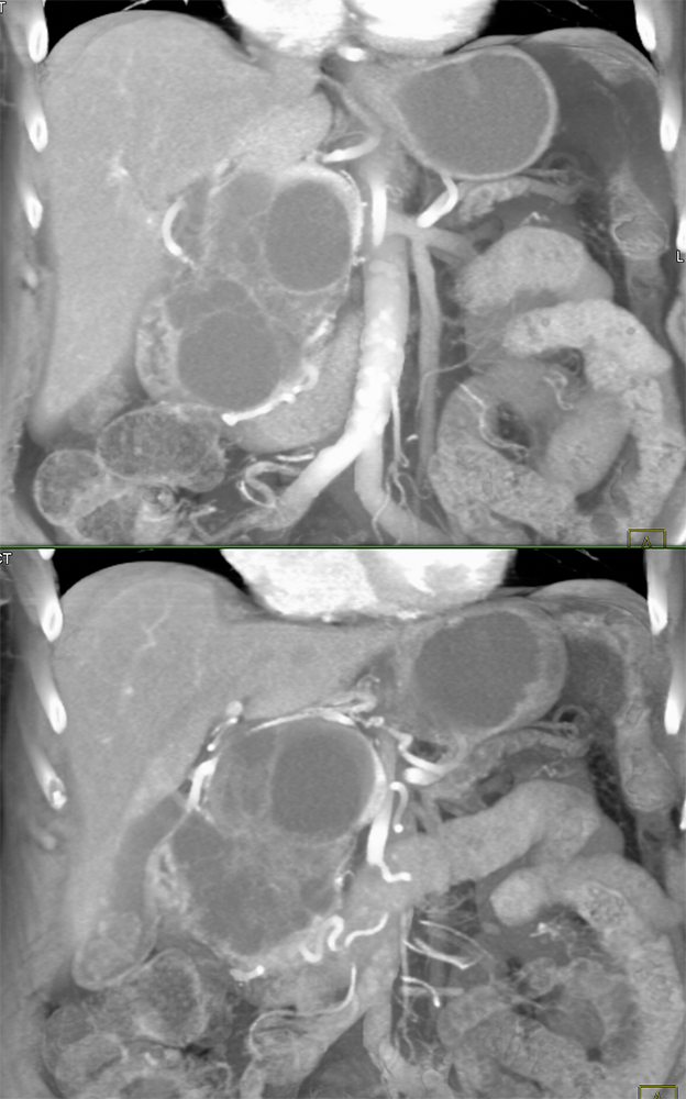 SPEN Tumors of the Pancreas