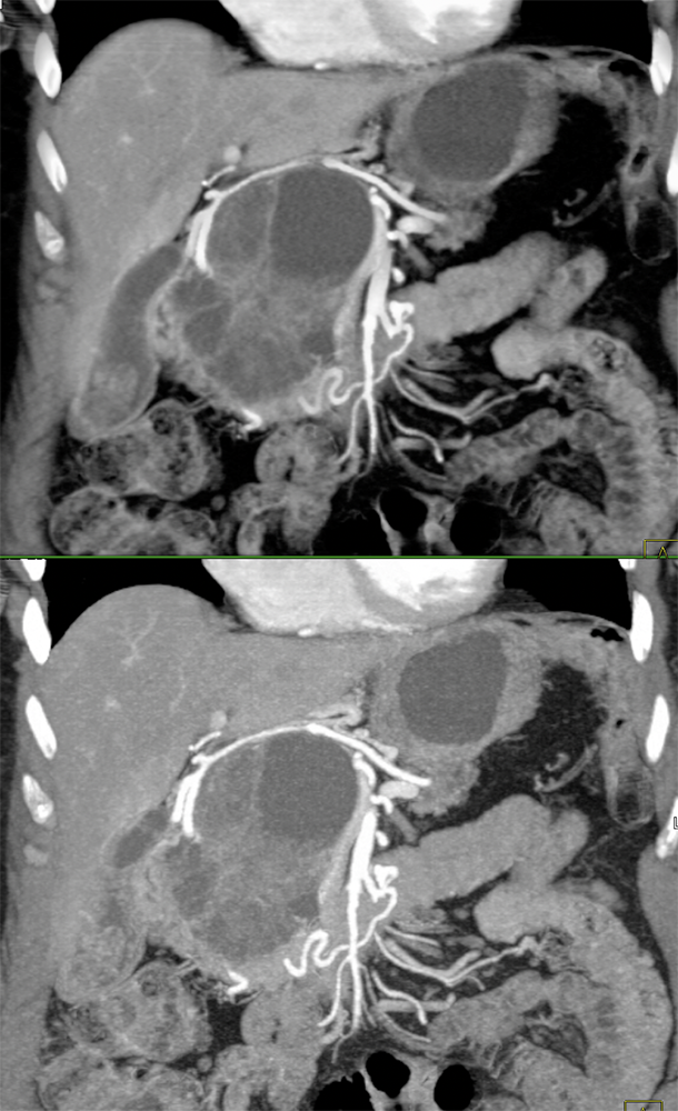 SPEN Tumors of the Pancreas