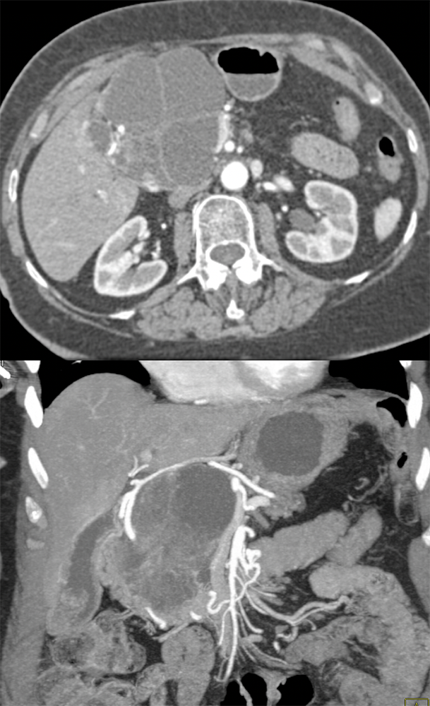 SPEN Tumors of the Pancreas