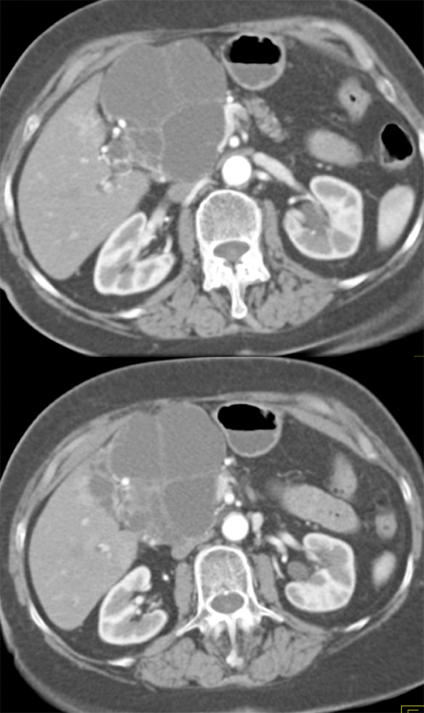 SPEN Tumors of the Pancreas