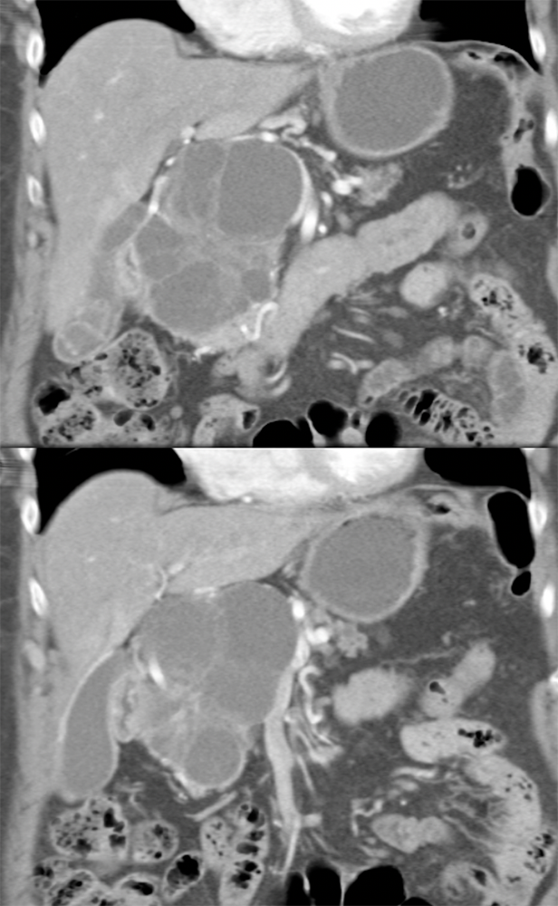 SPEN Tumors of the Pancreas