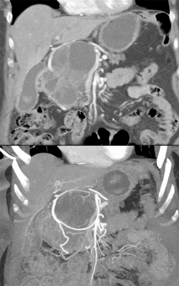 SPEN Tumors of the Pancreas