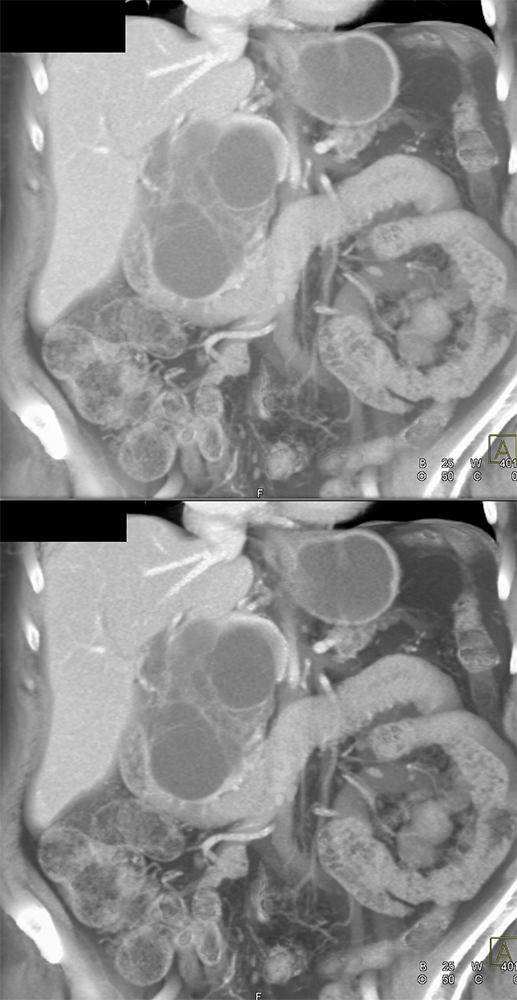 SPEN Tumors of the Pancreas